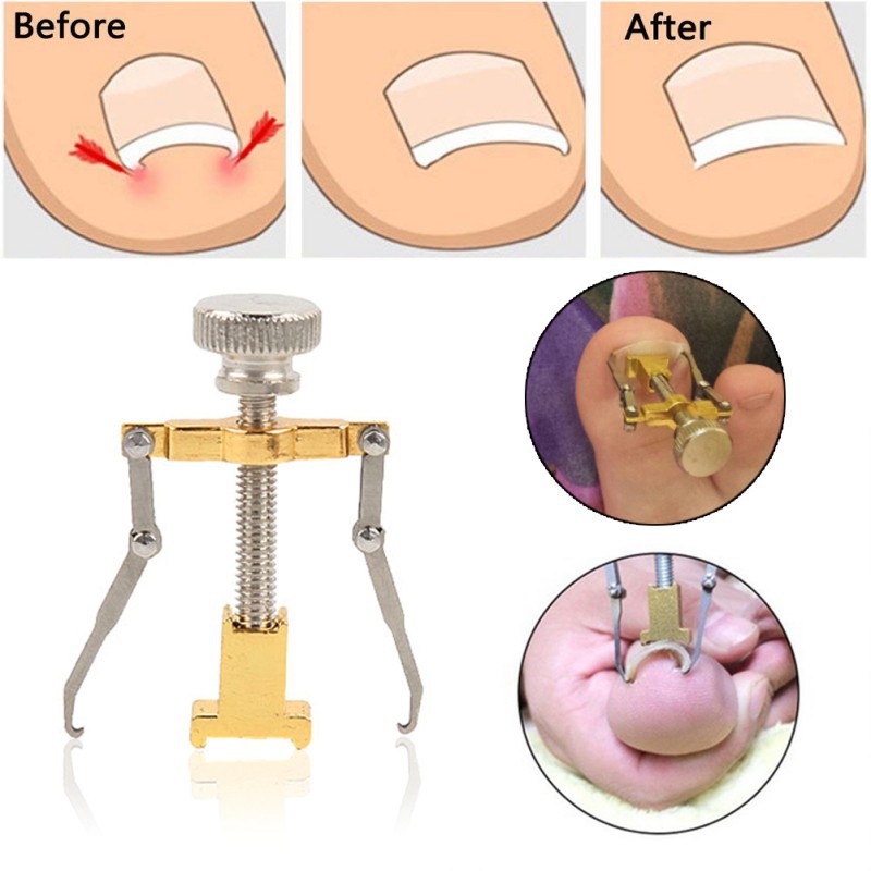 Ingrown Nail Corrector