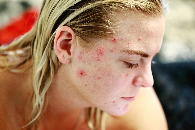 exfoliator exfoliation skin care blemish acne 