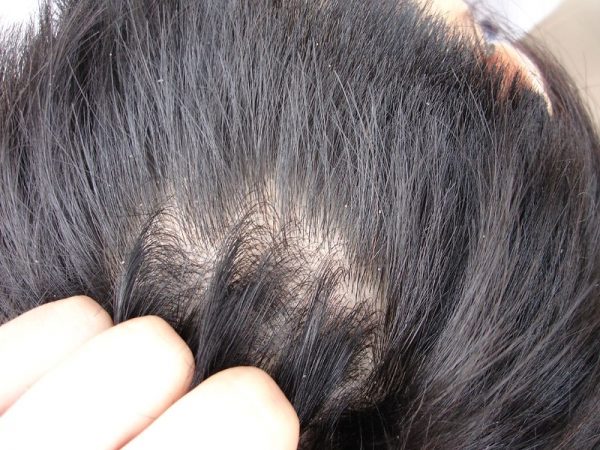 how to get rid of dandruff natural home remedies hair scalp