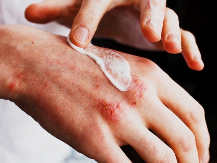 person applying cream on hand with eczema