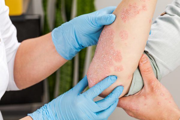 dermatologist blue glove eczema in singapore